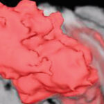 3D cystoscopy