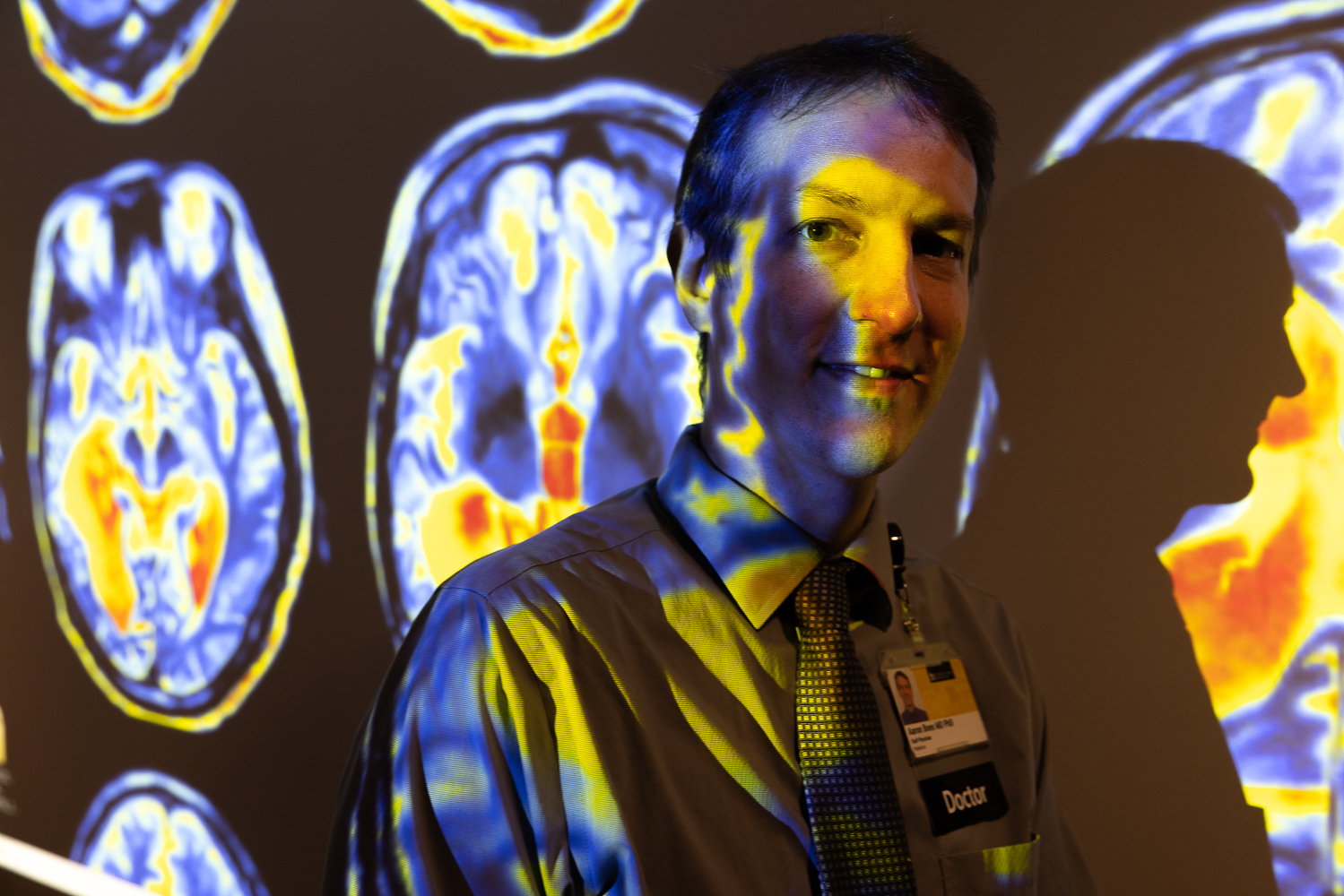 UI professor Dr. Aaron Boes studies the impact brain lesions has on addiction.