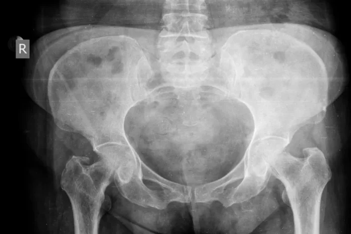 X-Ray of a pelvis